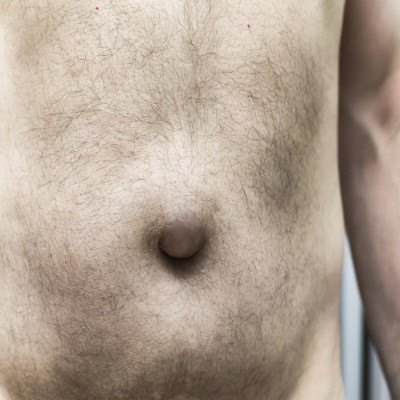 Cirugia de hernias en Maracaibo