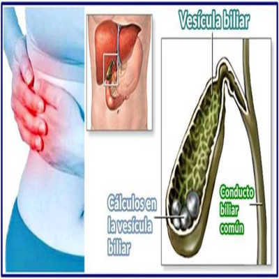 Cirugía de Vesícula( por cálculos) Maracaibo