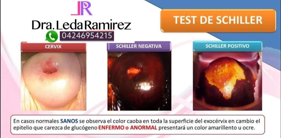 Citologia colposcopia y Biopsia