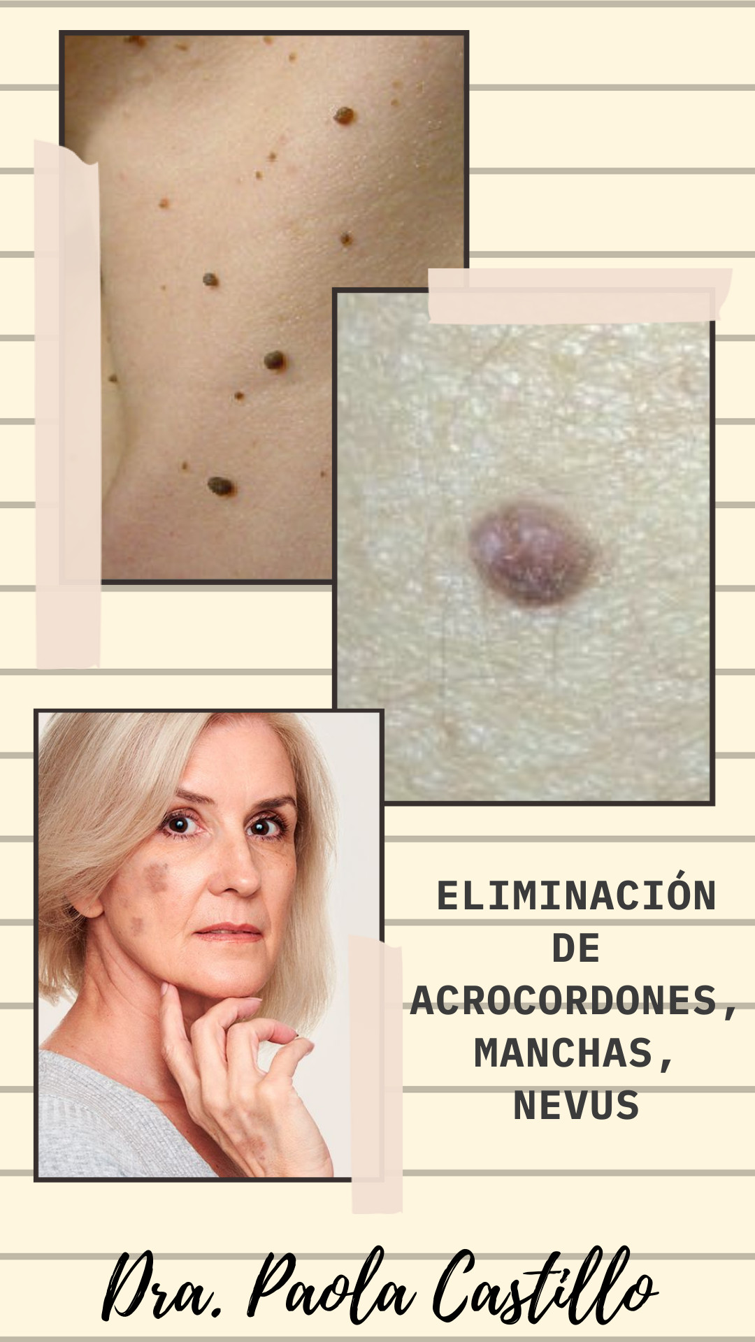 Eliminaciónde acrocordones, nevus, manchas